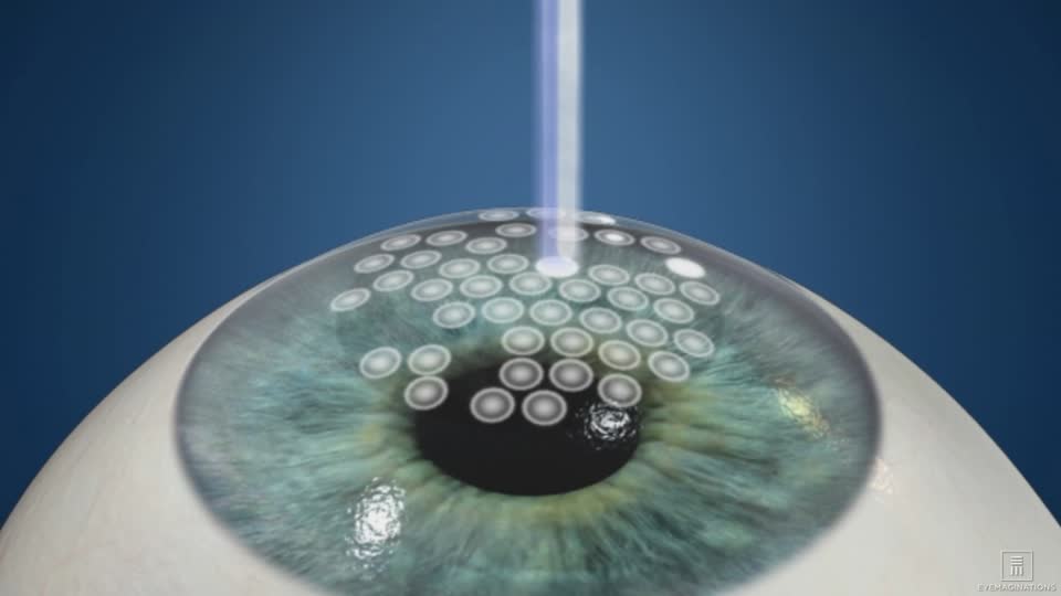 What to Know about Photorefractive keratectomy